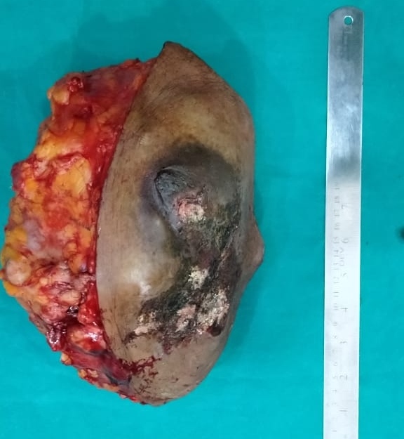 सोनौली कुनसेरवा: लाईफ केयर हॉस्पिटल में सबसे बड़े स्तन ट्यूमर का हुआ ऑपरेशन